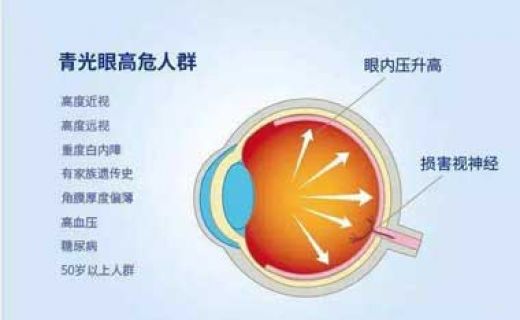 《上海大众卫生报》：「压力山大」可致青光眼