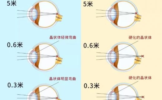 话匣子：科普｜近视+老花怎么办？一次手术解决两种困扰！